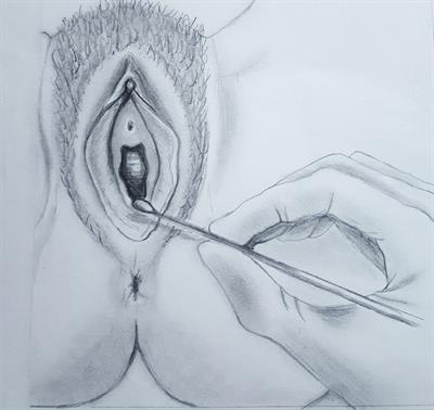 Localized Provoked Vulvodynia-An Ignored Vulvar Pain Syndrome